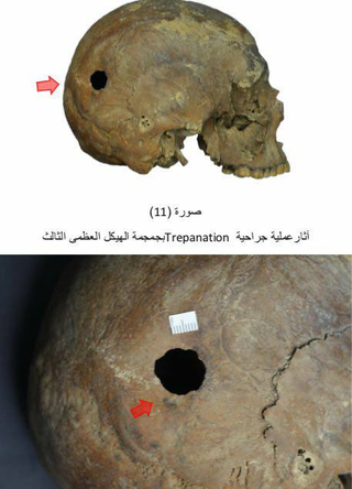 Evidence of trepanation—an early form of brain surgery—was discovered one one of the two male specimens.